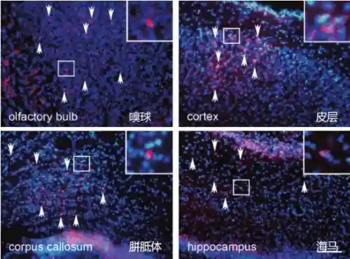 神经干细胞有望攻克小儿脑瘫顽症