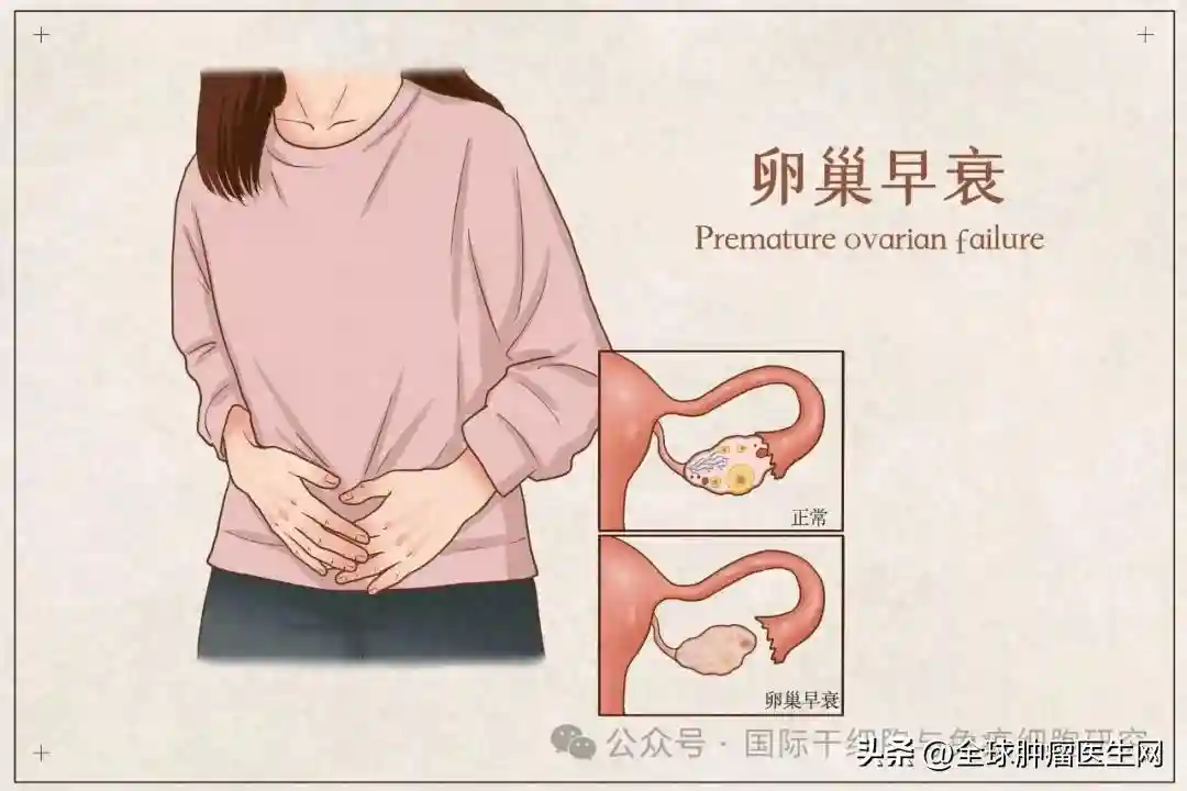 干细胞助卵巢早衰患者按下衰老暂停键，我国35例患者顺利完成治疗