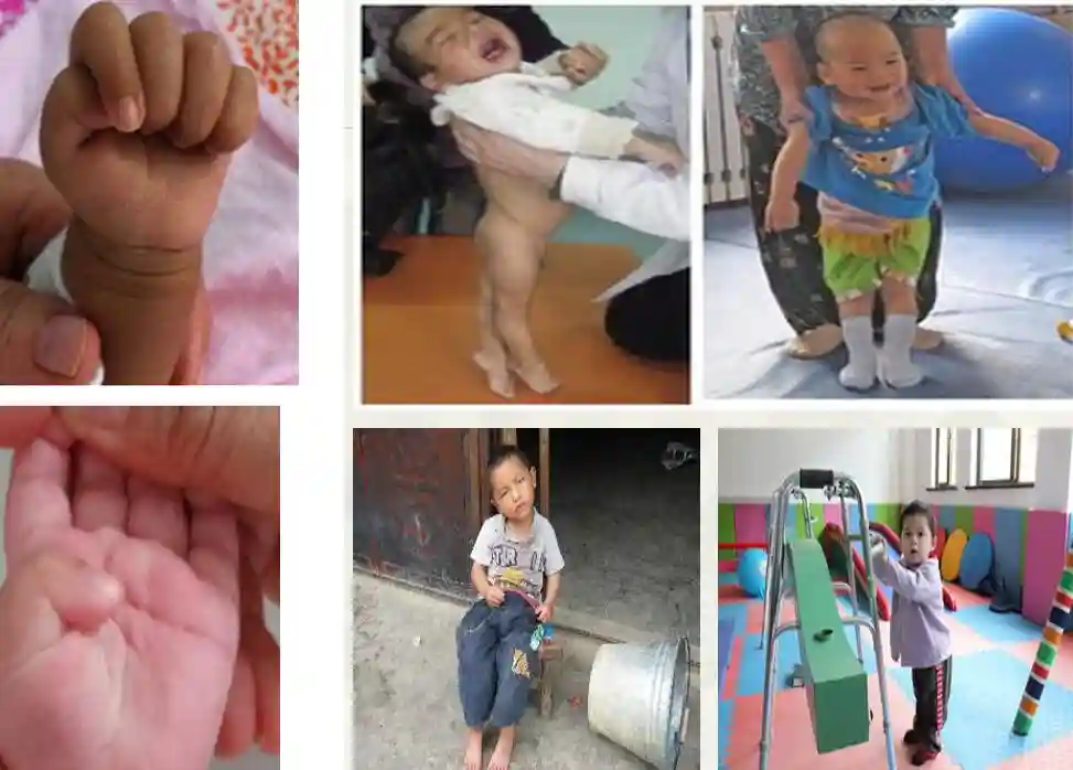 小儿脑损伤——​ 访南阳医专一附院儿科主任张晋雷