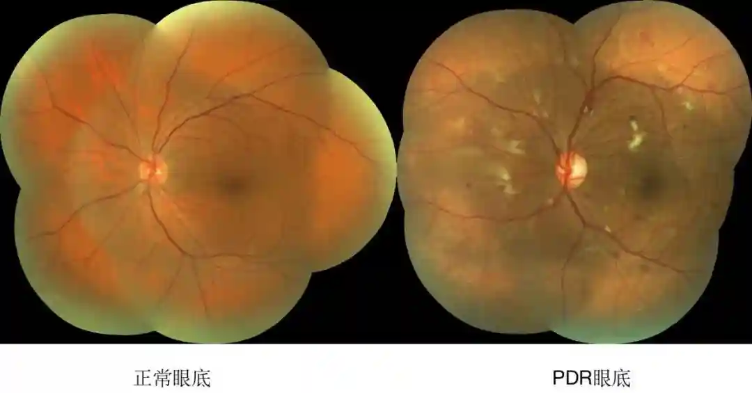 刘堃教授：O-GlcNAc糖基化修饰参与DR新生血管形成的前沿进展